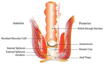 Laparoscopic Complete Excision of the Posterior Muscular Cuff: Technique Refinements and Comparison With Stepwise Gradient Muscular Cuff Cutting for Hirschsprung Disease